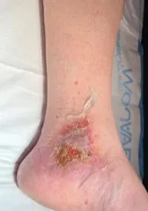 Ankle with a venous leg ulcer