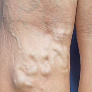 Varicose Veins