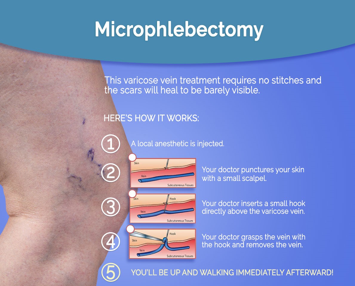 Microphlebectomy